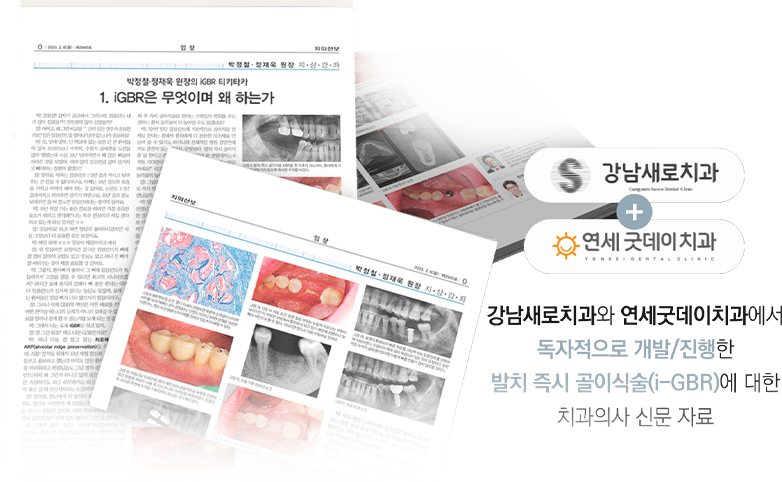 강남새로치과와 연세굿데이치과에서 독자적으로 개발/진행한 발치 즉시 골이식술(i-GBR)에 대한 치과의사 신문 자료