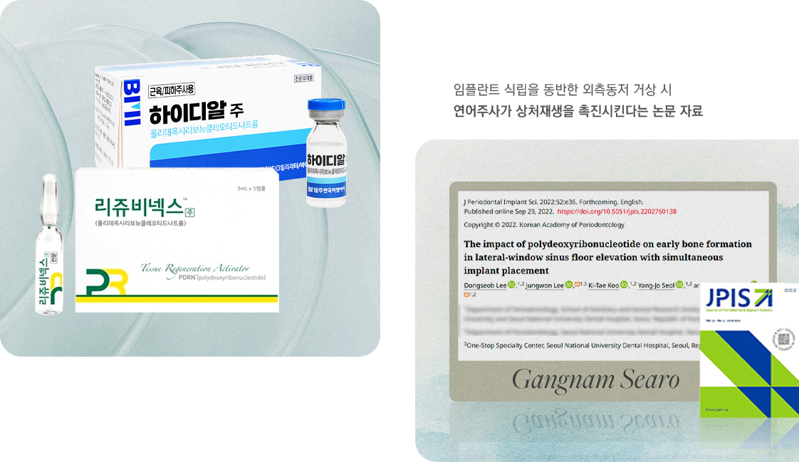 임플란트 식립을 동반한 외측동저 거상 시 연어주사가 상처재생을 촉진시킨다는 논문 자료